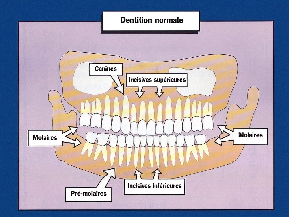 Différences entre dents et implants